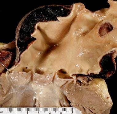 Thoracic Aortic Aneurysm Pathology. A 41-year-old 