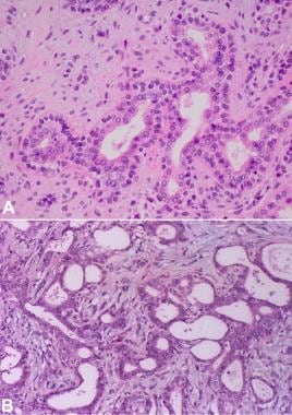 Pathology of Pleomorphic Adenoma. Cells in pleomor