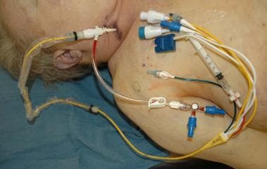 A photograph of a Swan-Ganz catheter at autopsy. T
