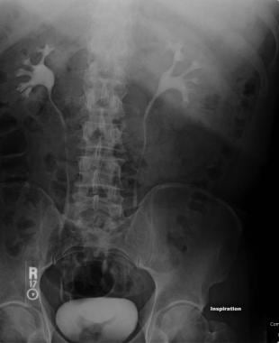 Excretory urography imaging sequence: A full KUB r