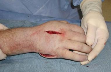 Single dorsal incision was made to gain access to 