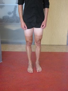 Assessing the Q angle for patellar instability. 