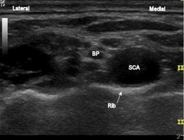 The brachial plexus (BP) and subclavian artery (SC