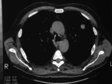 Mediastinal windows of the patient in the previous