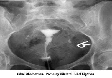 Infertility. Tubal obstruction: Pomeroy bilateral 