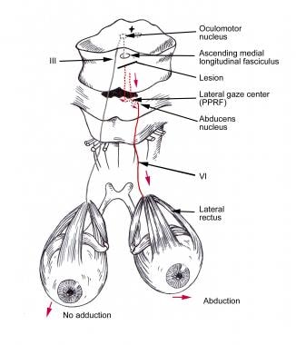 Lesion of the medial longitudinal fasciculus (MLF)