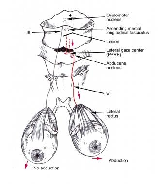 medial longitudinal fasciculus pathway