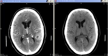 Grade III astrocytoma in a 71-year-old man. Contra