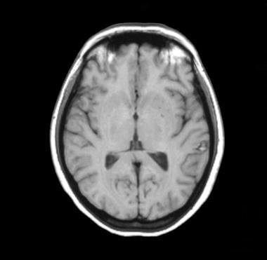 T1-weighted MRI demonstrates a small hyperintense 