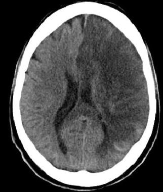 Noncontrast CT in this 52-year-old male with histo