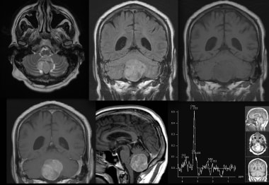 MRI images with the following sequences: axial T2,