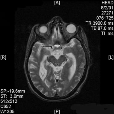 Axial T2-weighted magnetic resonance image through