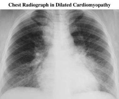 Chest radiograph in a patient presenting with hear