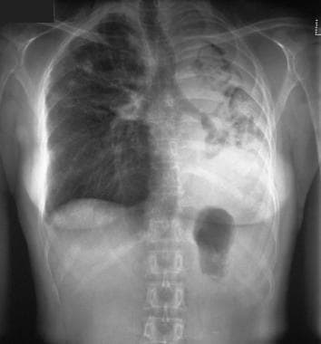 Posteroanterior chest radiograph shows multiple as