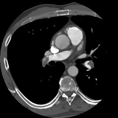 Pulmonary hypertension. CT pulmonary angiogram in 