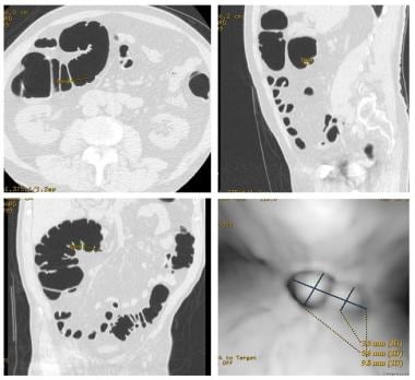 Axial, coronal, and sagittal CT images highlightin