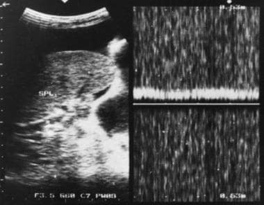 多普勒超音波在脾门显示肝