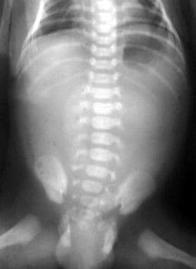 Autosomal recessive polycystic kidney disease (ARP