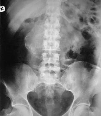 Plain abdominal radiograph of a patient with biops