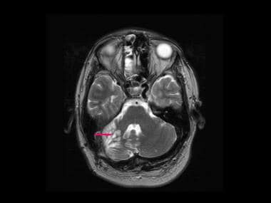 von Hippel-Lindau syndrome. Axial T2-weighted MRI 