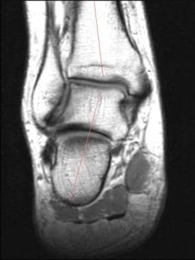 Ankle, tibialis posterior tendon injuries. Coronal
