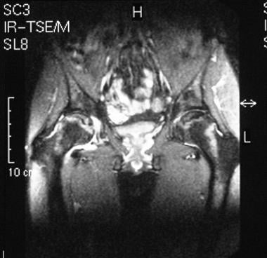 Coronal T2-weighted MRI in a 35-year-old man with 