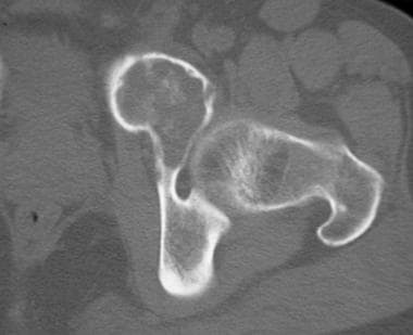 Bone-window CT scan of left acetabulum demonstrate