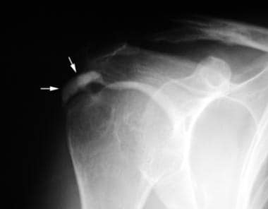 Anteroposterior radiograph performed in external r