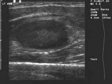 Ultrasound image demonstrates another example of a