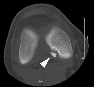 Axial CT of the knee demonstrates a completely det