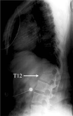 Thoracic spine trauma. Lateral radiograph of the t