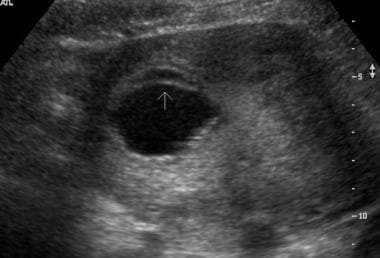 Intrauterine blood clot  Radiology Reference Article