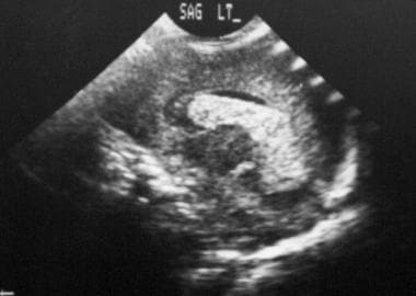 Sagittal ultrasonogram. The image shows intraventr