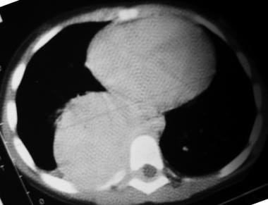 Nonenhanced axial CT scan of the chest in a patien