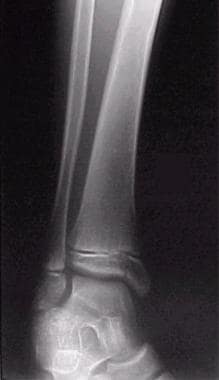 Salter-Harris type III fracture of the distal tibi