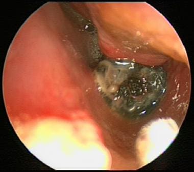 Foreign body is shown in the left nasal cavity wit