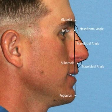 Common nasal angles used for lateral view nasal as