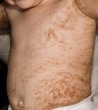 Blaschkoid hyperpigmentation in an infant with inc