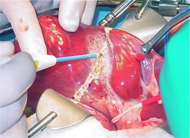 Electrocautery is useful for dissecting through th