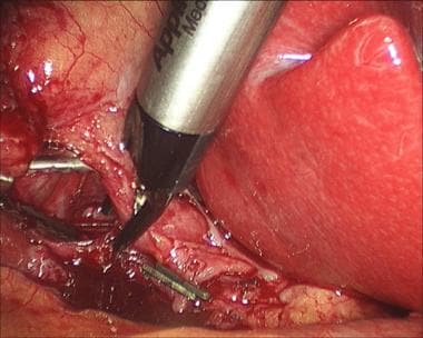 Laparoscopic cholecystectomy. Placement of clip at