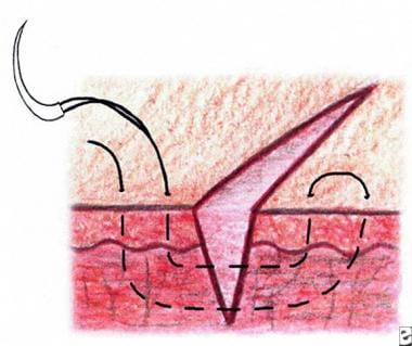 Vertical mattress suture. 