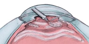 Cataract surgery with phacoemulsification cross-se