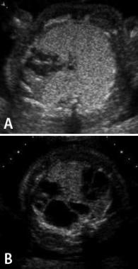 Sonographic images of fetal congenital pulmonary a
