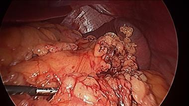 Dissection below the inferior border of pancreatic