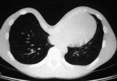 Preoperative CT scan of the chest of 12-year-old g