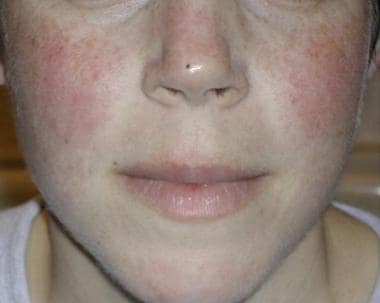 Systemic lupus erythematosus