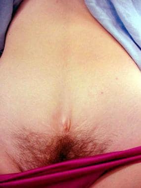 Female with covered exstrophy. Umbilicus is very l