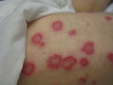 Papules and annular plaques. 