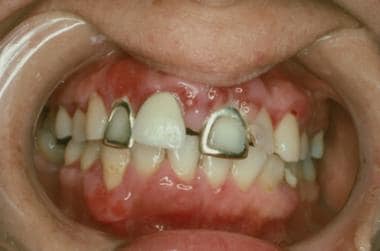 Swelling of the gingival mucosa around the right l