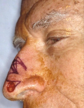 Postoperative Mohs defect over the left tip of the